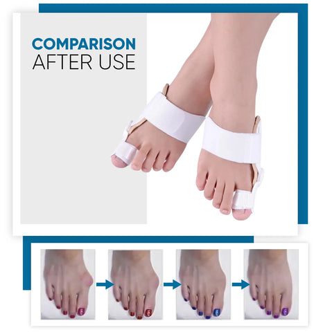 Bunion Corrector Strap | BioSkin Innovative Bracing Solutions