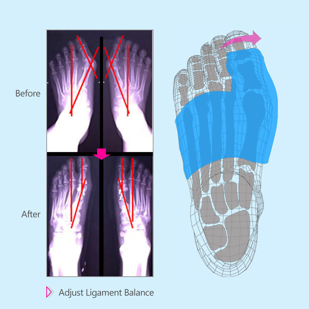 PumpTrex Bunion Corrector and Toe Separator with Air Pump for Adjustable  Compression, Durable Straps for Full Support