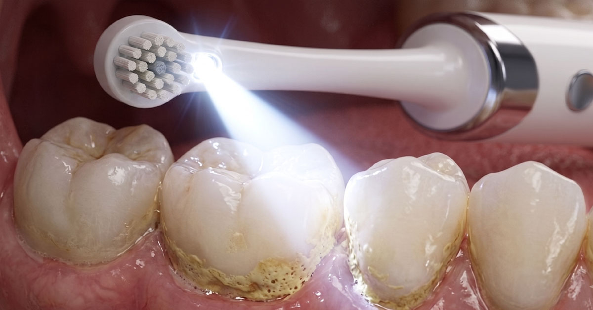 360° LED Light Illuminates Hidden Plaque and Stains