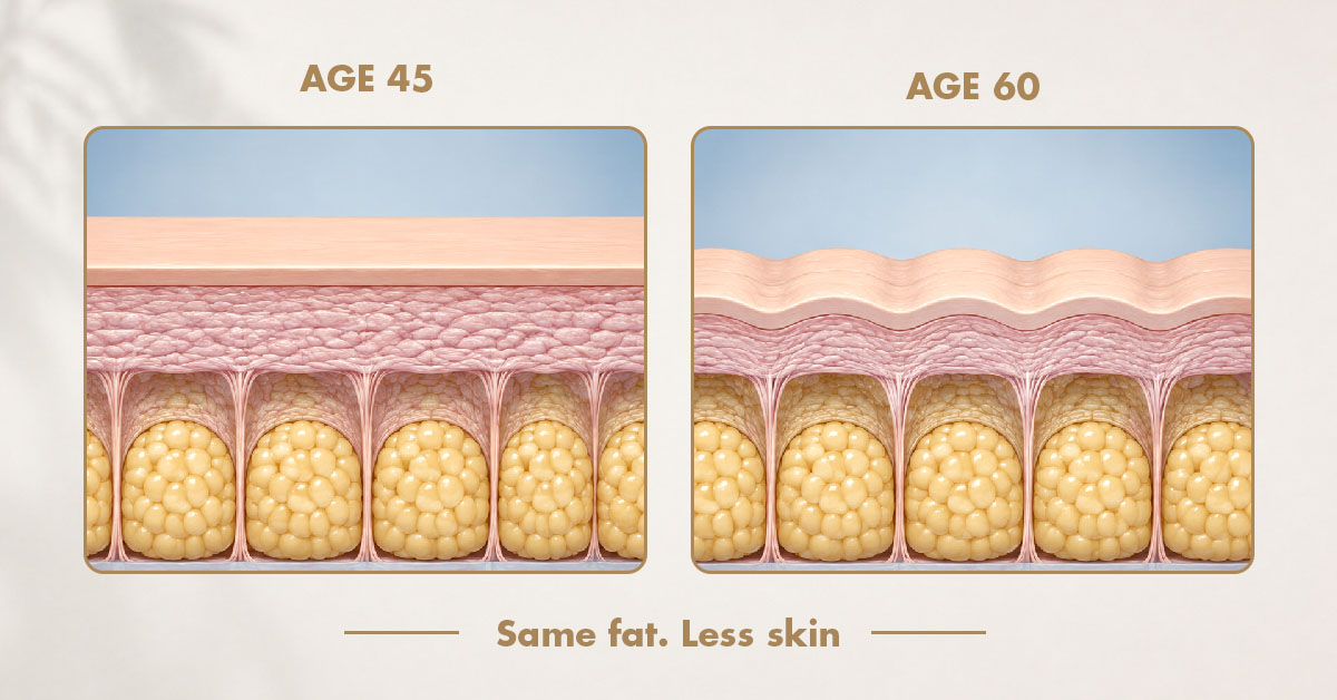 Mechanism over the dimple. Cross-section showing the puckered surface, cords, and fat compartments, with a suction cup sealed over it and the fold visibly lifted clear inside the cup. Two arrows: "lifts the skin off the cords" and "moves fluid through." Same visual language and palette as the hero so the reader recognises it as the same diagram, now with a tool applied.